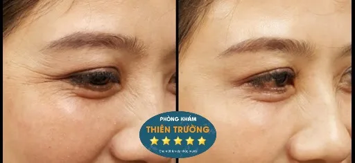 Hình ảnh: Trước và sau khi xóa nhăn vùng mắt