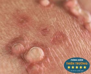 Hình ảnh: Mụn cóc sinh dục