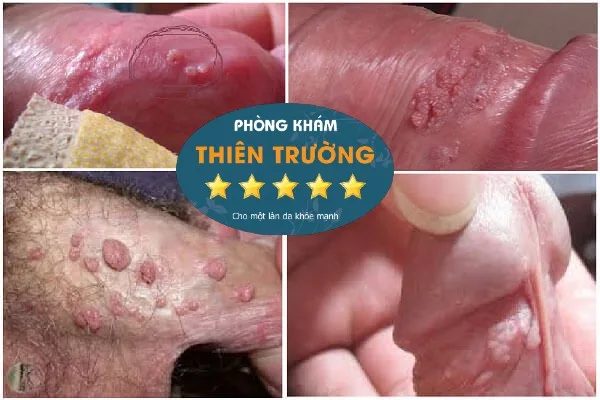 Hình ảnh: Mụn cóc sinh dục ở nam giới