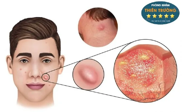 Hình ảnh: Mụn bọc, mụn nang.