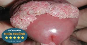 Hình ảnh: Mụn cóc sinh dục ở nam giới