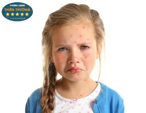 Hình ảnh: Mụn trứng cá ở trẻ em.