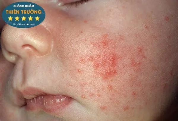 Hình ảnh: Mụn trứng cá ở trẻ em.