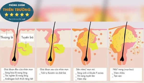 Hình ảnh: Các giai đoạn hình thành mụn trứng cá.