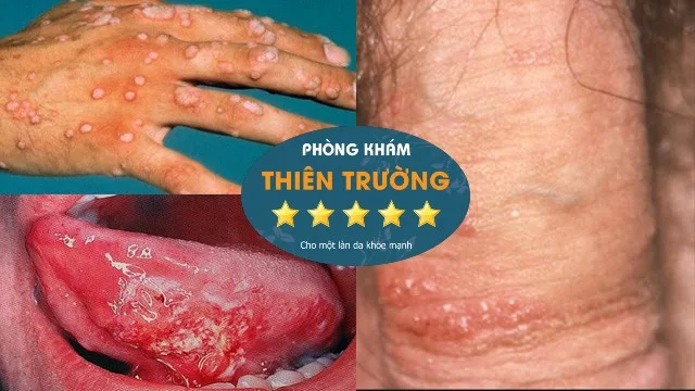 Hình ảnh: Mụn cóc sinh dục ở nam giới.