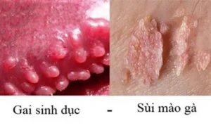 Hình ảnh: U nhú sinh dục và sùi mào gà.