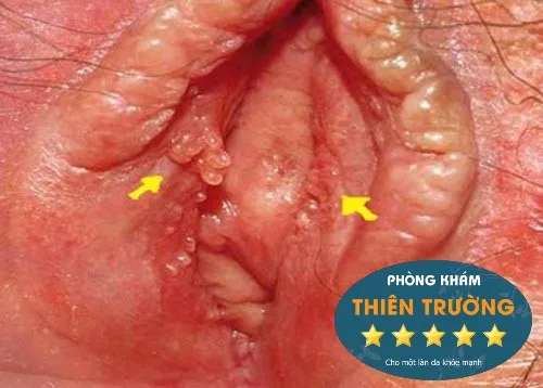 Hình ảnh: U nhú sinh dục nữ.