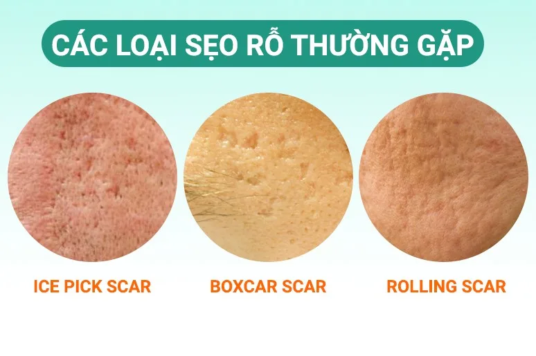 phân loại sẹo rỗ
