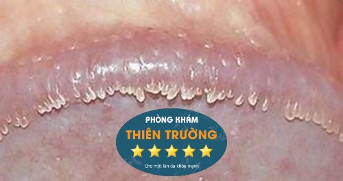 Thuốc Bôi U Nhú Sinh Dục Tại Nhà - Da liễu Thiên Trường