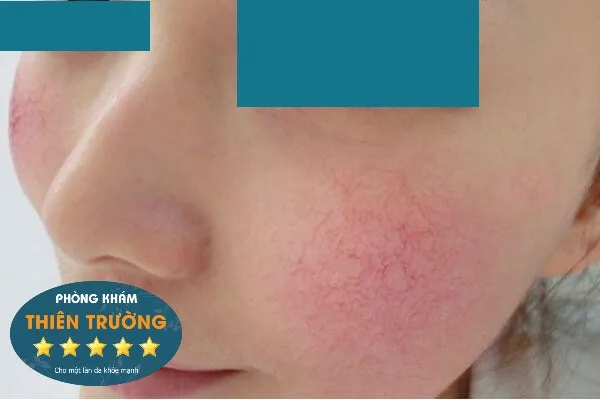 Hình ảnh: Da yếu do sử dụng kem trộn.