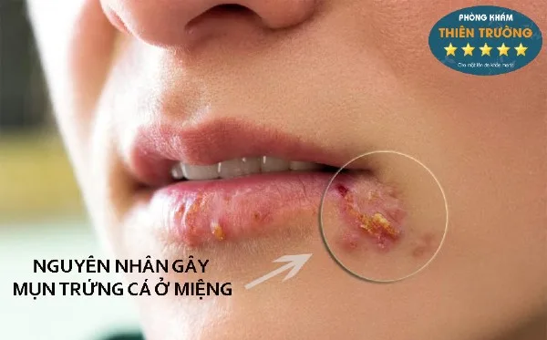 Hình ảnh: Mụn trứng cá quanh miệng.