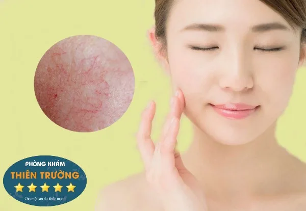 Hình ảnh: Da bị giãn mao mạch.