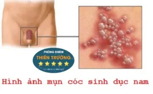 Hình ảnh: Mụn cóc sinh dục ở nam giới.