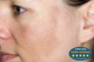 Hình ảnh: Nám mảng nhẹ.