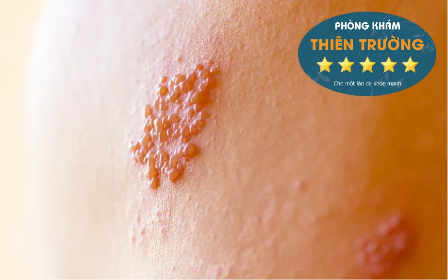 20191211_114748_323299_benh_zona.max-1800x1800