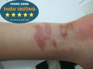 Hình ảnh: Biếu hiện zona thần kinh.