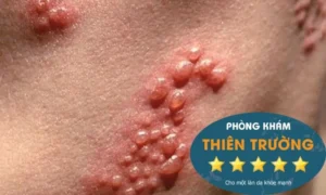 Hình ảnh: Biểu hiện zona thần kinh.