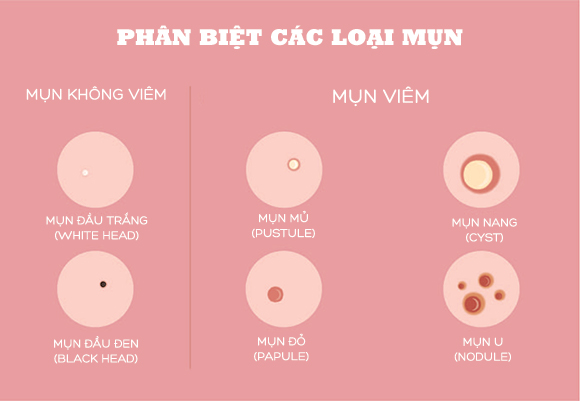 Hình ảnh: Phân biệt các loại mụn