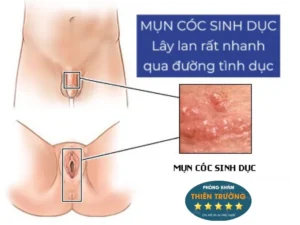 Hình ảnh: Mụn cóc sinh dục lây lan qua đường tình dục.