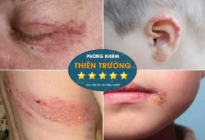 Hình ảnh: Biểu hiện zona thần kinh.