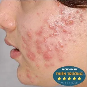 Hình ảnh: Mụn trứng cá.