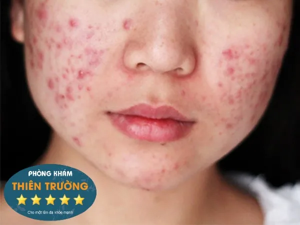 Hình ảnh: Mụn bọc hai bên má.