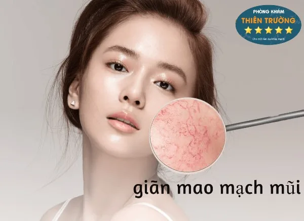 Hình ảnh: Giãn mao mạch trên mặt.