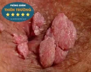 Hình ảnh: Mụn cóc sinh dục hậu môn.