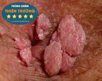 Hình ảnh: Mụn cóc sinh dục hậu môn.