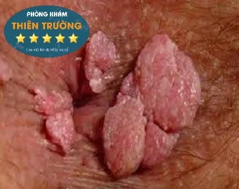 Hình ảnh: Mụn cóc sinh dục hậu môn.