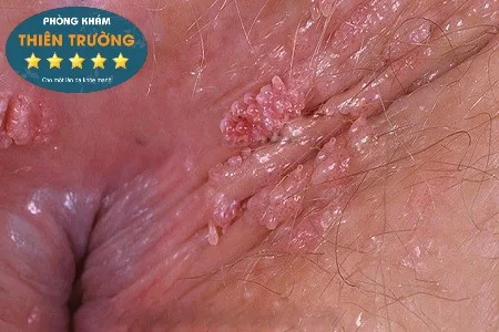 Hình ảnh: Mụn cóc sinh dục hậu môn.