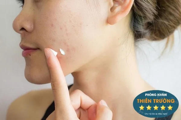 Hình ảnh: Lưu ý khi dùng kem trị mụn.