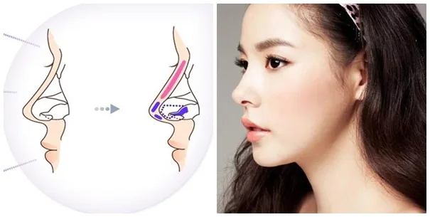 Hình ảnh: Tạo hình nâng mũi không phẫu thuật