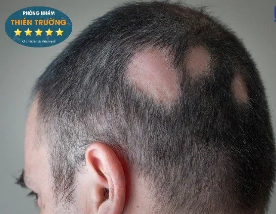 Hình ảnh: Rụng tóc từng mảng.