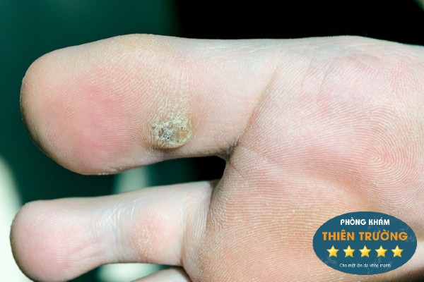 Hình ảnh: Mụn ocsc thông thường.