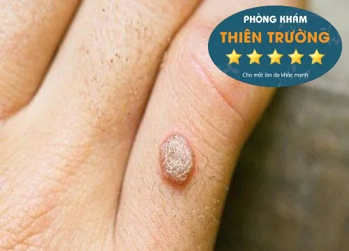 Hình ảnh: Mụn cóc sinh dục ở tay.