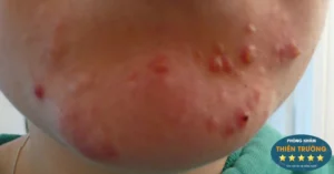 Hình ảnh: Mụn bọc ở cằm.