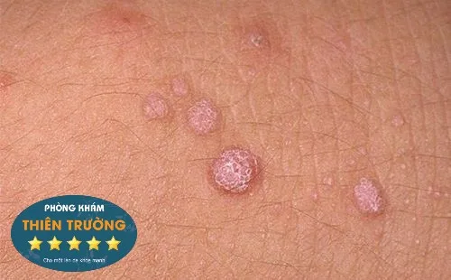 ob_94c9a7_mun-coc-sinh-duc