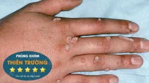 Hình ảnh: Mụn cóc sinh dục ở tay.