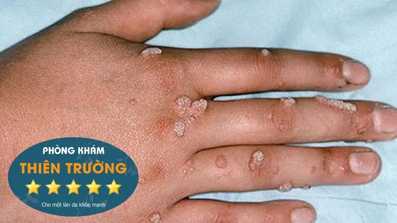 Hình ảnh: Mụn cóc sinh dục ở tay.