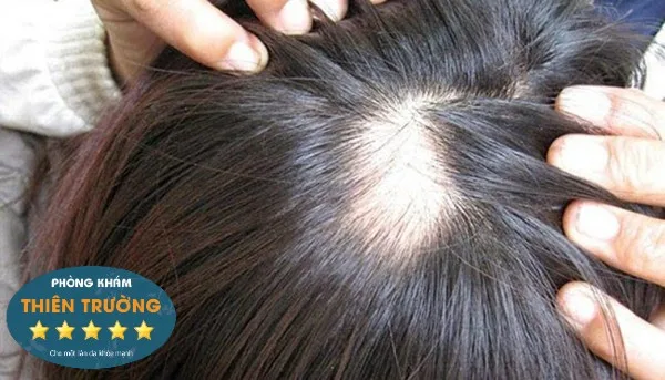 Hình ảnh: Rụng tóc.