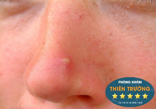Mụn bọc ở mũi có thể xuất hiện do vấn đề liên quan đến hệ tiêu hóa không?
