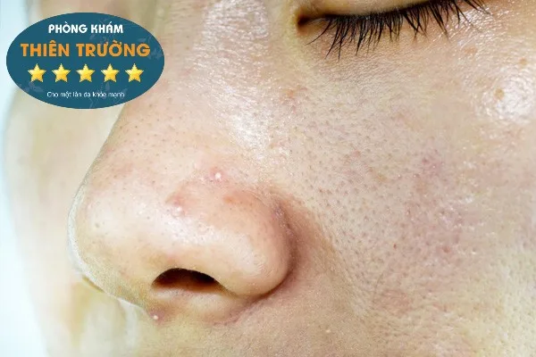 Hình ảnh: Da dầu mụn.