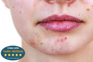 Hình ảnh: Mụn ẩn sưng đỏ.