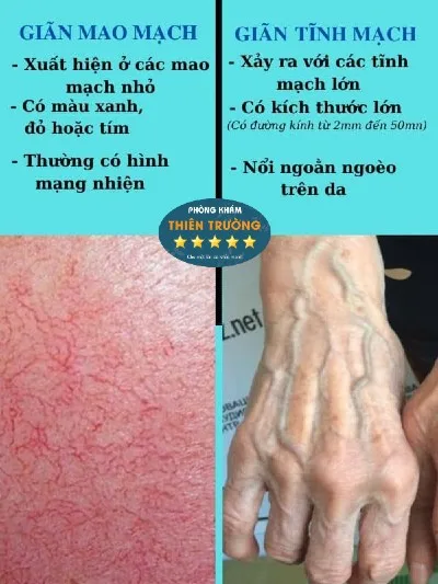 Hình ảnh: Phân biệt giãn mao mạch và giãn tĩnh mạch.