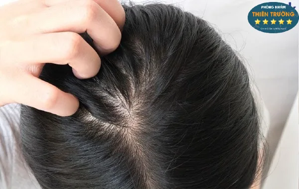 Hình ảnh: Giảm rụng tóc tận gốc