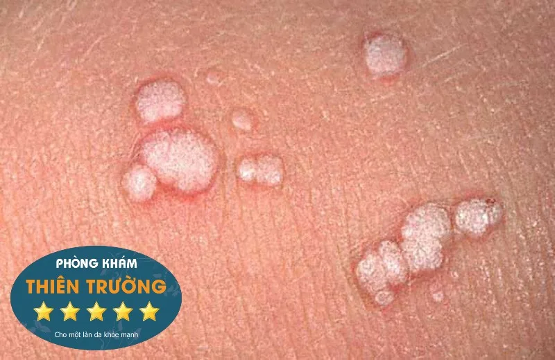 487-mun-com-sinh-duc-9559-5b06