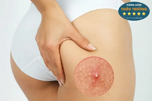Hình ảnh: Mụn trứng cá ở mông.