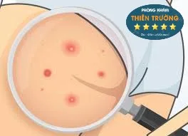 Hình ảnh: Mụn mọc ở mông.