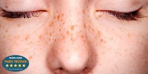 Hình ảnh:Tàn nhang